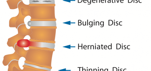 Дисковата херния